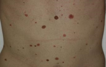 Naevus dysplasiques