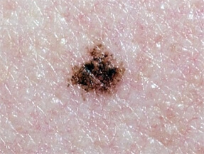 mélanome en microscopie confocale