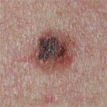Mélanome débutant