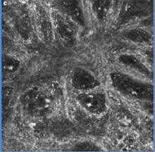 mélanome en microscopie confocale