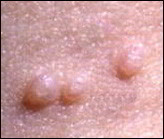 Molluscum Contagiosum
