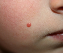 Naevus de Spitz