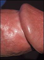 papules