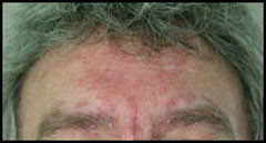 psoriasis du visage