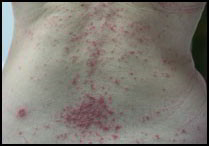 psoriasis pustuleux généralisé