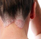 Psoriasis